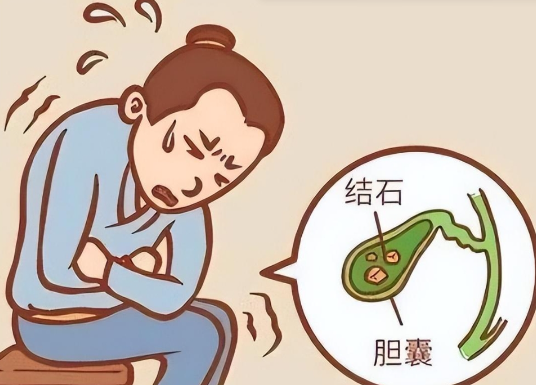 胆囊结石