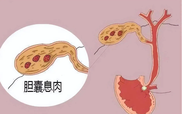 胆囊息肉