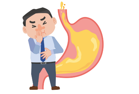 反流性食管炎