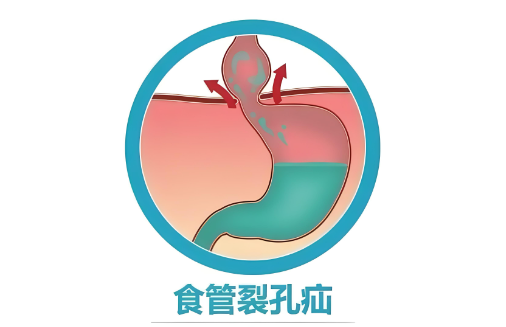 食管裂孔疝